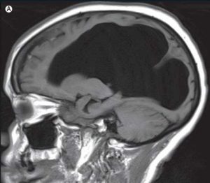 Su Dolu Bir Beyinle Yaşayabilir Miyiz?